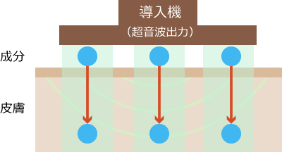 ソノフォレーシス