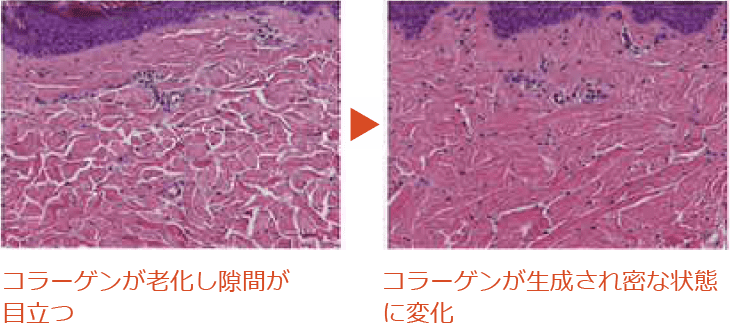 コラーゲンが老化し隙間が目立つ　コラーゲンが生成され密な状態に変化